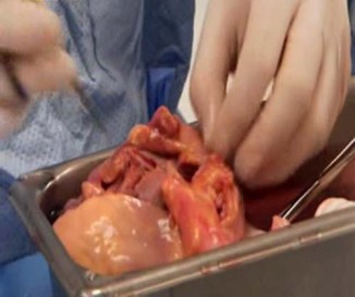 Syrian Refugees Organs traded